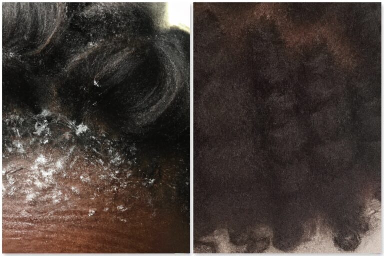 Close-up of dandruff on scalp and textured hair